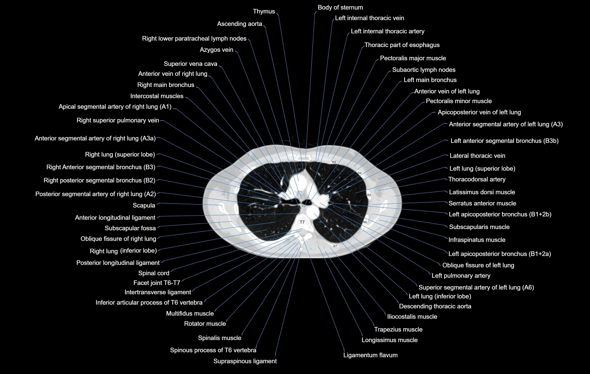 CT chest (thorax) lung window window labelled axial cross sectional anatomy radiology image-00049.webp